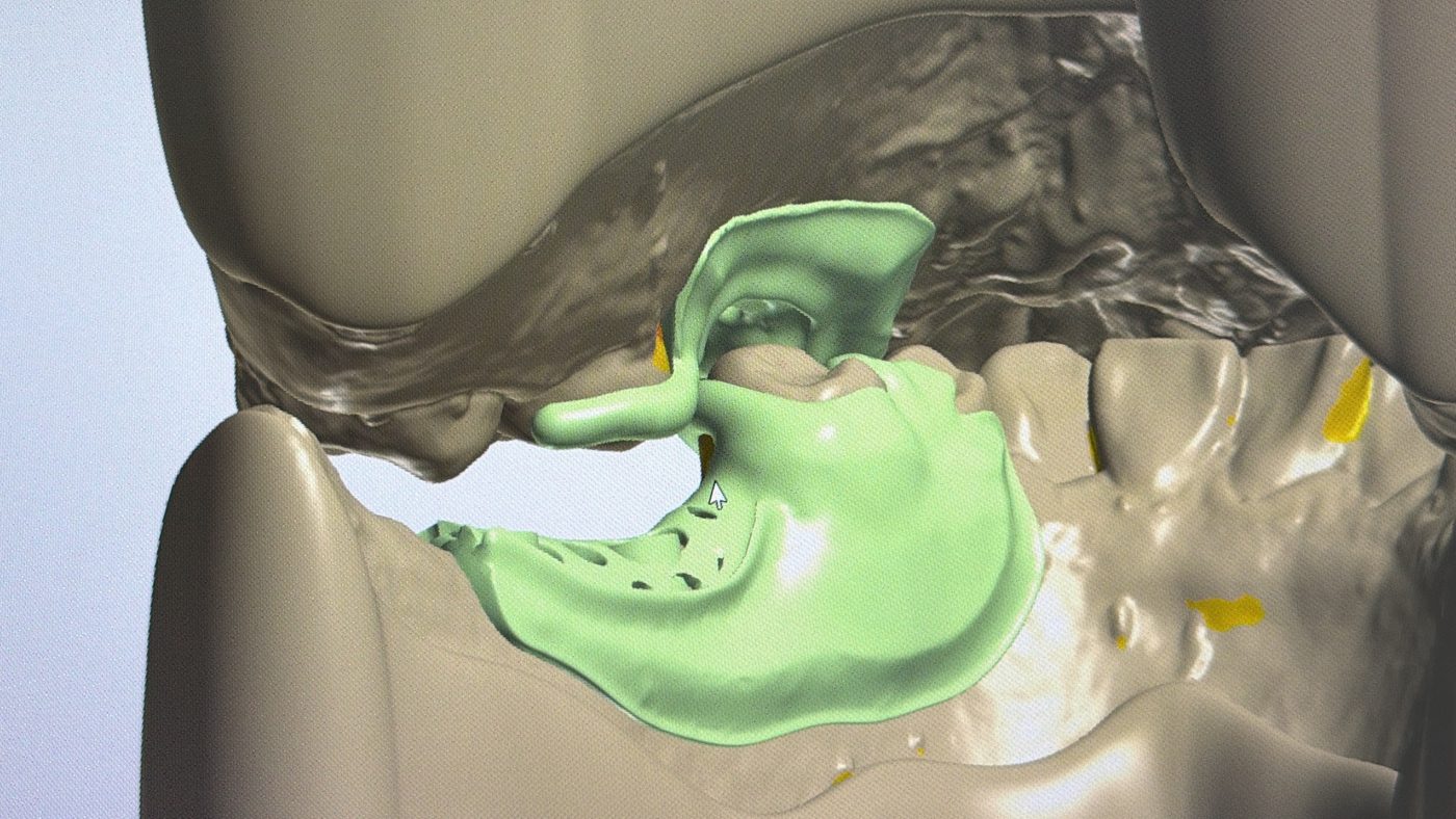 Diseño CAD de estructura de removible — Laboratorio Dental NIX