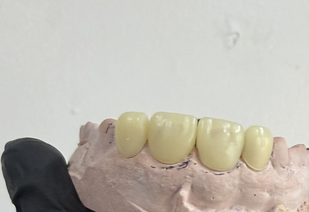 Coronas anteriores terminadas — Laboratorio Dental NIX