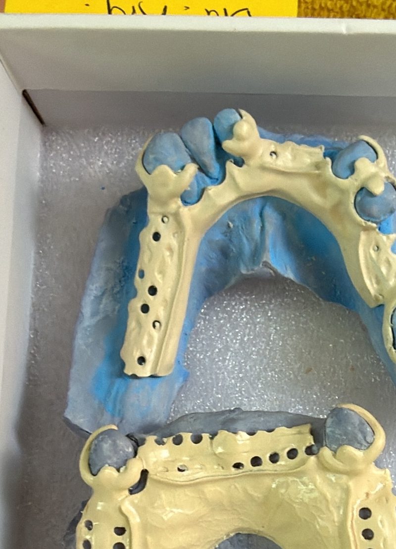 Estructuras de removible listas para prueba — Laboratorio Dental NIX